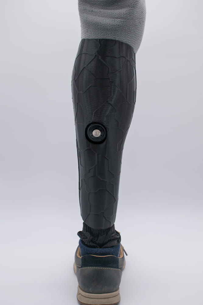 3D gedrucktes Prothesencover mit Aussparung für ein Luftausstoßventil.